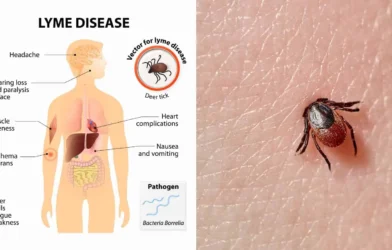 Lyme disease is a tick-borne illness caused by the bacterium Borrelia burgdorfer