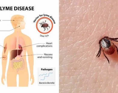 Lyme disease is a tick-borne illness caused by the bacterium Borrelia burgdorfer