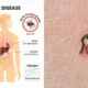 5 Warning Signs Of Lyme Disease To Never Ignore 80x80