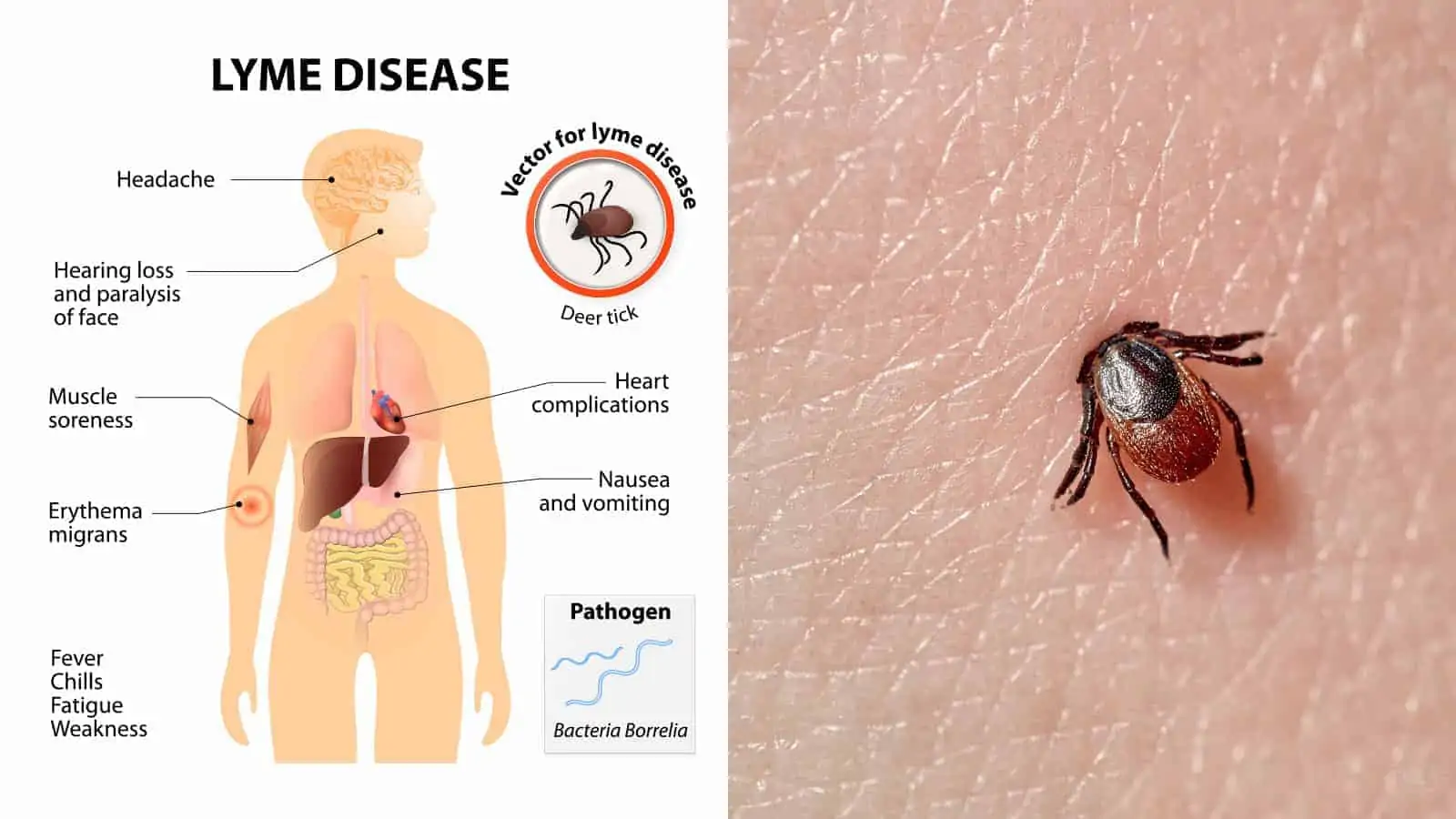 Lyme disease is a tick-borne illness caused by the bacterium Borrelia burgdorfer