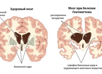 Huntington’s disease is a rare but serious genetic disorder that affects the brain and nervous system. It is passed down.