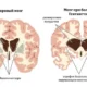Huntington’s disease is a rare but serious genetic disorder that affects the brain and nervous system. It is passed down.