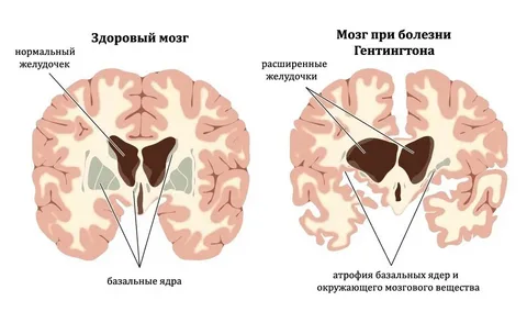 Huntington’s disease is a rare but serious genetic disorder that affects the brain and nervous system. It is passed down.